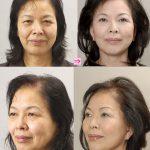フェイスリフトで美人に変身　（画像あり）