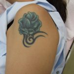 刺青を取りたい　二の腕　（画像あり）