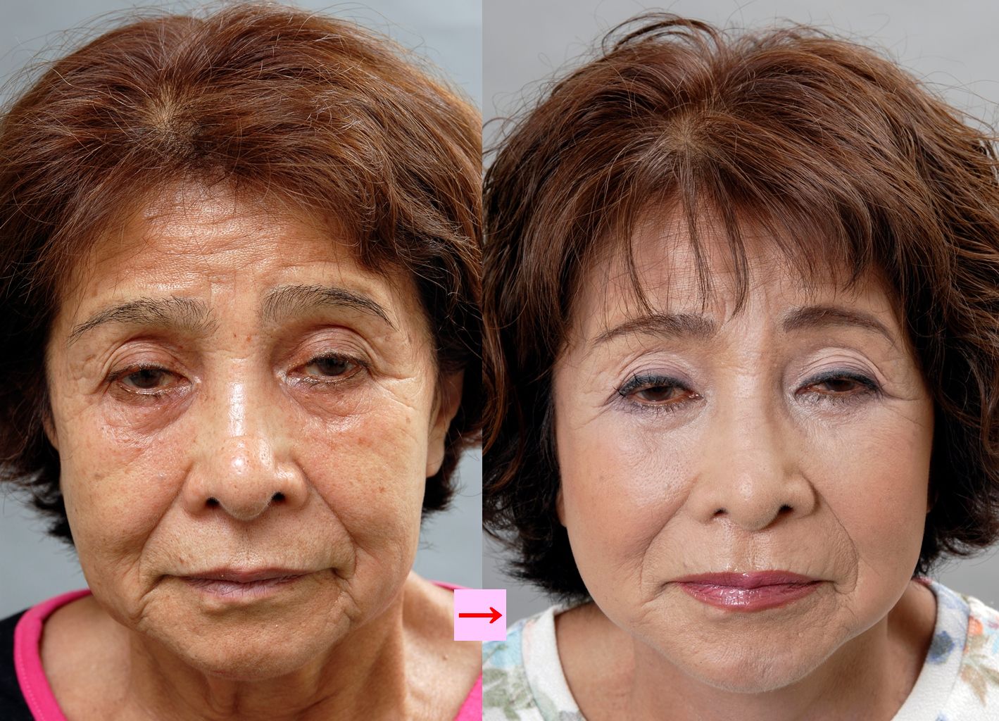 フェイスリフトとリガメント 画像あり 横浜で働く美容外科院長の美容整形ここだけの話ブログ フェイスリフトとリガメント 画像あり 横浜で働く美容外科院長の美容整形ここだけの話ブログ