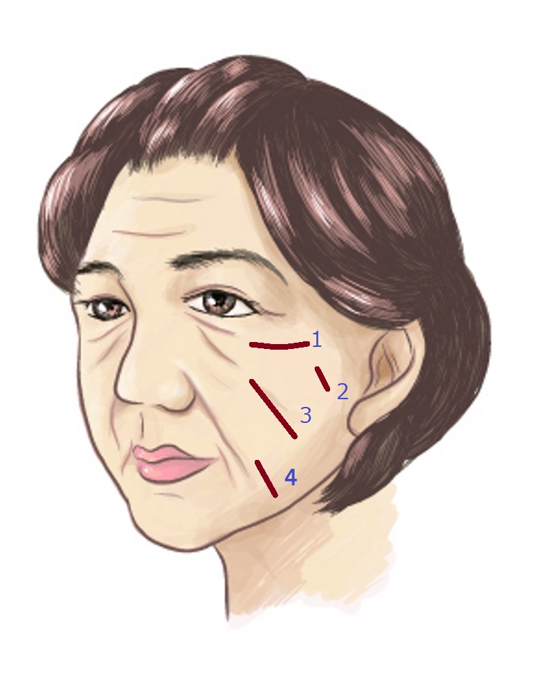 フェイスリフトとリガメント 画像あり 横浜で働く美容外科院長の美容整形ここだけの話ブログ フェイスリフトとリガメント 画像あり 横浜で働く美容外科院長の美容整形ここだけの話ブログ