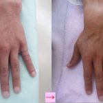 刺青を取りたい　手　（画像あり）