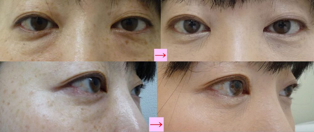 失敗しない病院選び 目の下くま取り 30代 2 画像あり 横浜で働く美容外科院長の美容整形ここだけの話ブログ