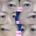 腫れぼったいマブタの二重まぶた・部分切開法　（画像あり）