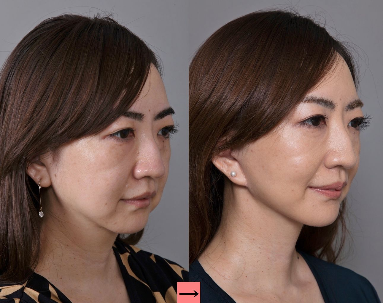 フェイスリフト 症例解説 横浜で働く美容外科院長の美容整形ここだけの話ブログ