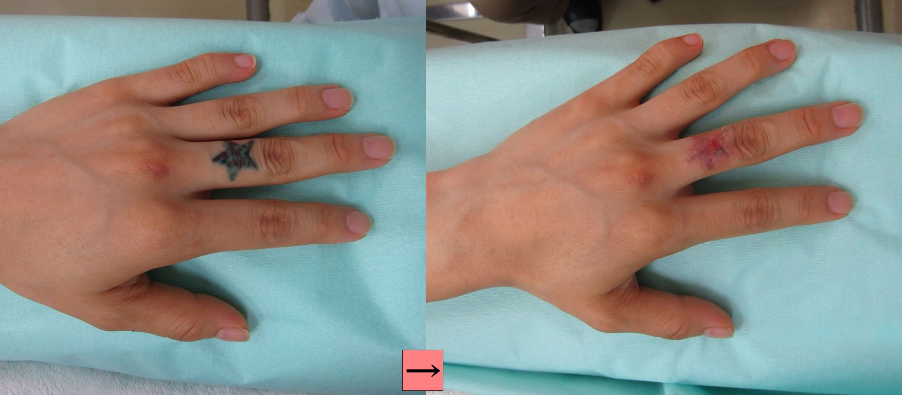 指の入れ墨 タトゥー 除去なら傷跡を残さない削皮術 特徴紹介 横浜で働く美容外科院長の美容整形ここだけの話ブログ