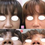 団子鼻、鼻尖縮小と小鼻縮小、どちらが効果的？　（画像あり）