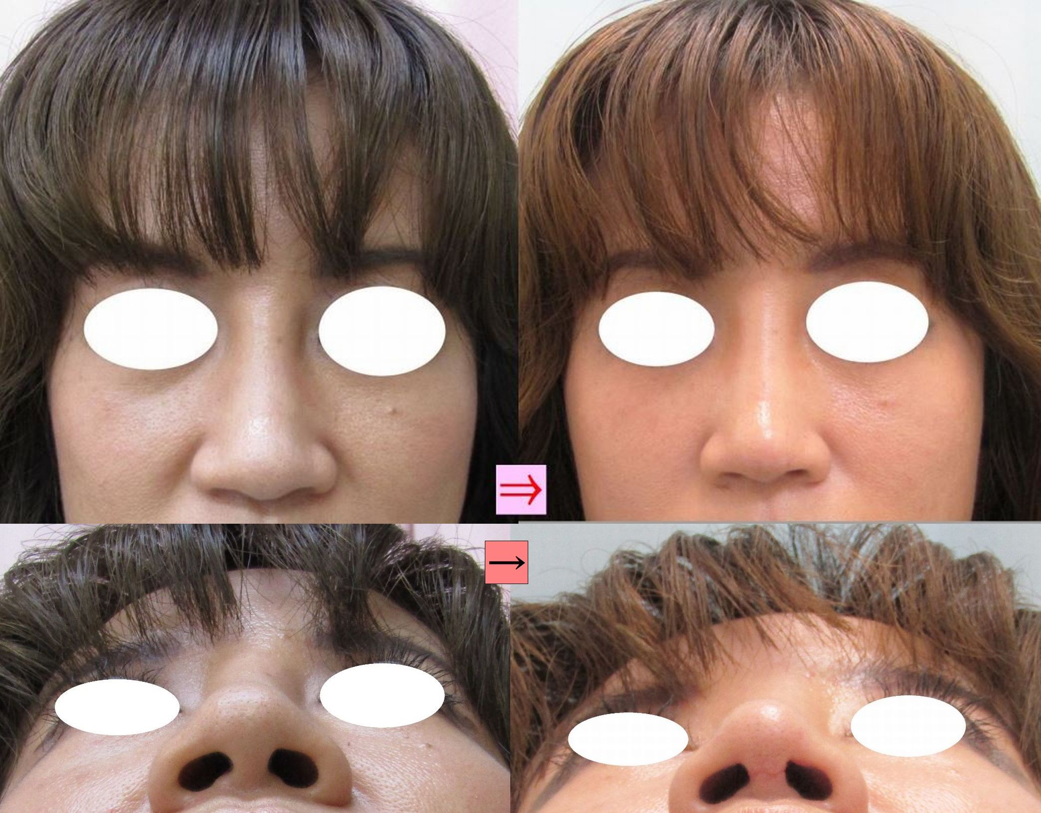 団子鼻 鼻尖縮小と小鼻縮小 どちらが効果的 画像あり 横浜で働く美容外科院長の美容整形ここだけの話ブログ