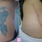 刺青を取りたい　手術とレーザー、どちらがいいの？　（画像あり）