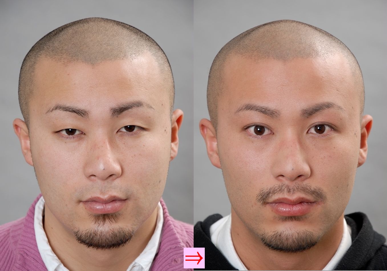 二重まぶた 埋没法は元に戻りやすいか 画像あり 横浜で働く美容外科院長の美容整形ここだけの話ブログ 二重まぶた 埋没法は元に戻りやすいか 画像あり 横浜で働く美容外科院長の美容整形ここだけの話ブログ