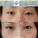 目を大きくしたい　目頭切開と目尻切開の違い　（画像あり）