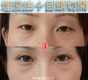 目を大きくしたい 目頭切開と目尻切開の違い 画像あり 横浜で働く美容外科院長の美容整形ここだけの話ブログ