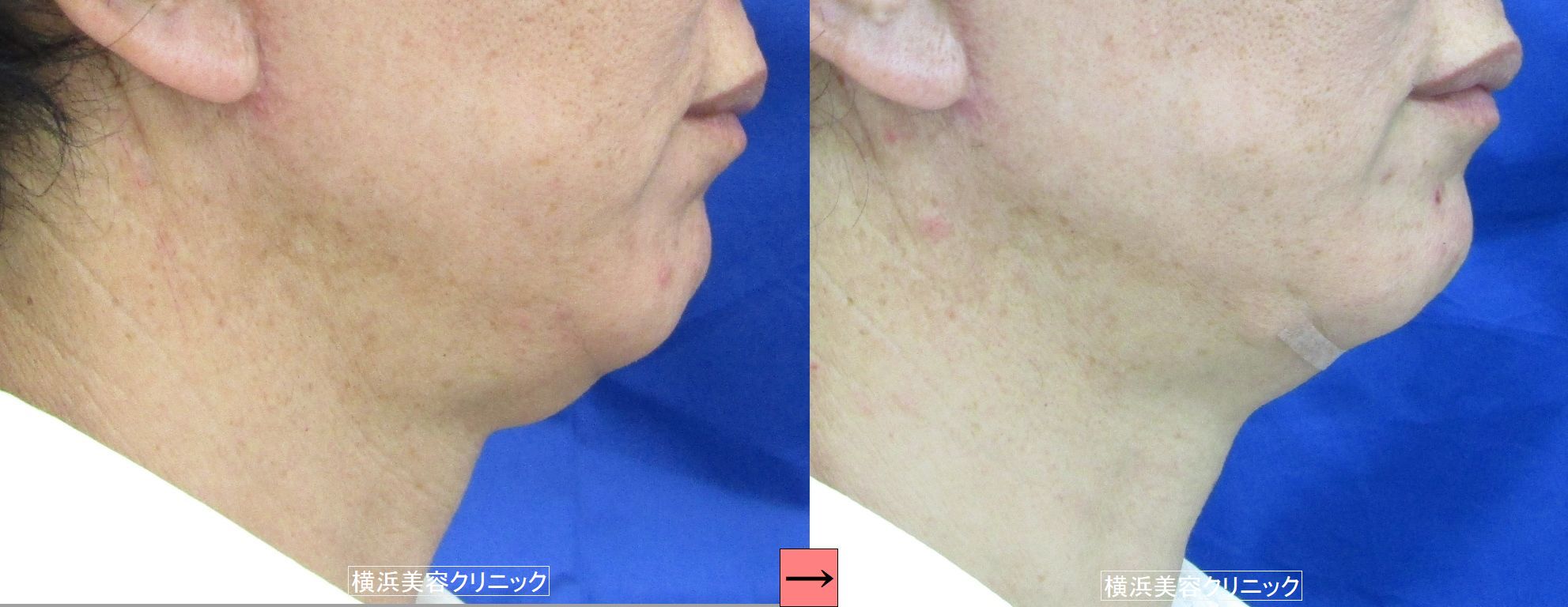 首のたるみ ネックリフトと二重あごリフトの違い 画像あり 横浜で働く美容外科院長の美容整形ここだけの話ブログ 首のたるみ ネックリフトと二重あごリフトの違い 画像あり 横浜で働く美容外科院長の美容整形ここだけの話ブログ