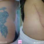 刺青を消したい、切除法とレーザー治療の違い　（画像あり）