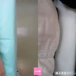 刺青除去　前腕　（画像あり）