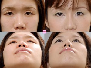 隆鼻術 小鼻縮小 画像あり 横浜で働く美容外科院長の美容整形ここだけの話ブログ