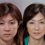 フェイスリフト（切開リフト）症例解説　（画像あり）
