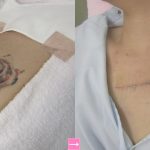 胸の入れ墨（タトゥー）除去なら┃施術効果や症例写真をご紹介