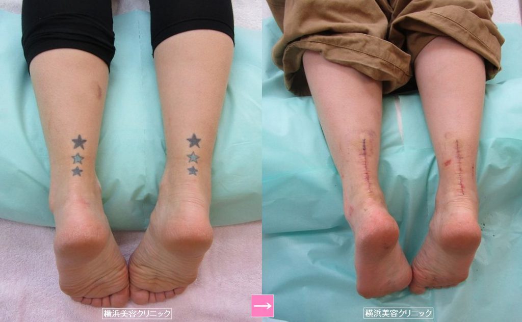 刺青除去 ふくらはぎ 画像あり 横浜で働く美容外科院長の美容整形ここだけの話ブログ