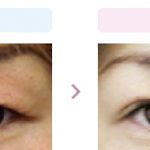 上まぶたのタルミに対する施術　（画像あり）