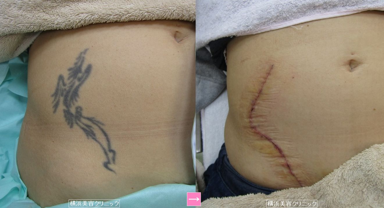 刺青除去 お腹 画像あり 横浜で働く美容外科院長の美容整形ここだけの話ブログ