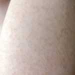 二の腕のぶつぶつ（毛孔性苔癬）の原因と解消法をご紹介！