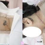 刺青を取りたい　首　（画像あり）