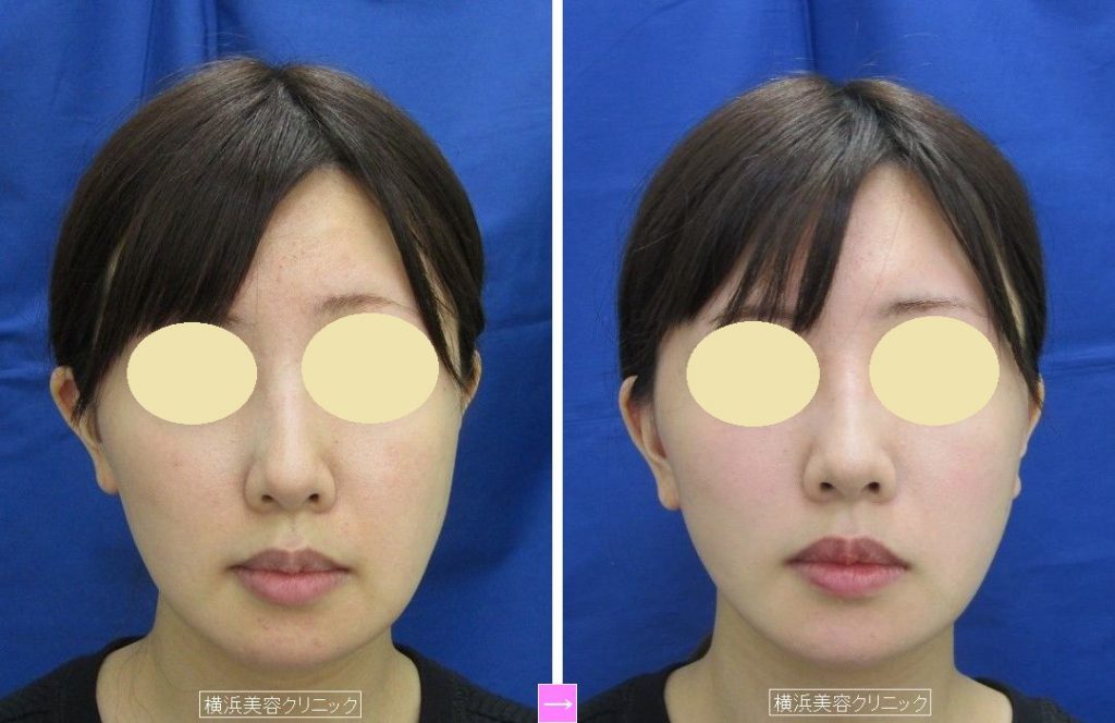 ２０代女性のフェイスリフト 切開リフト 過激な骨削りや脂肪吸引に注意 画像あり 横浜で働く美容外科院長の美容整形ここだけの話ブログ