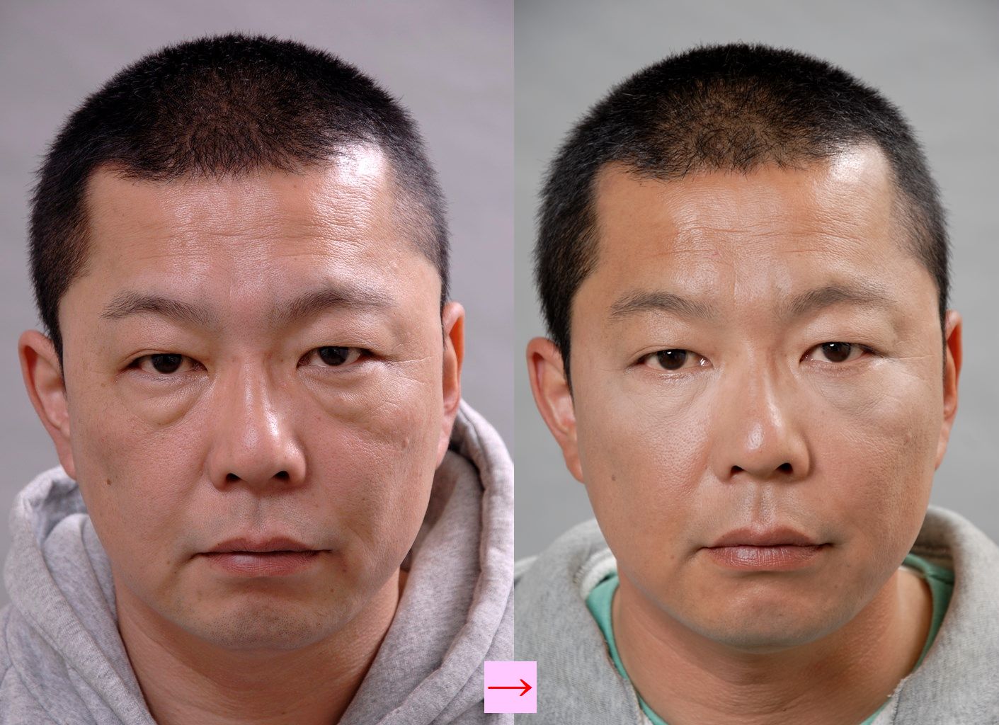 人相が悪く見える男性の目の下の膨らみを改善 画像あり 横浜で働く美容外科院長の美容整形ここだけの話ブログ