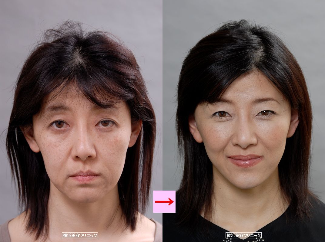 フェイスリフト 切開リフト でフェイスラインをスッキリと 画像あり 横浜で働く美容外科院長の美容整形ここだけの話ブログ フェイスリフト 切開リフト でフェイスラインをスッキリと 画像あり 横浜で働く美容外科院長の美容整形ここだけの話ブログ