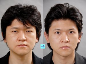 目を大きくするには二重まぶたにするのが一番 画像あり 横浜で働く美容外科院長の美容整形ここだけの話ブログ