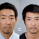 男性に多い美容外科施術　２　（画像あり）