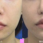 人中短縮術　（画像あり）