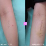 刺青除去　前腕　（画像あり）
