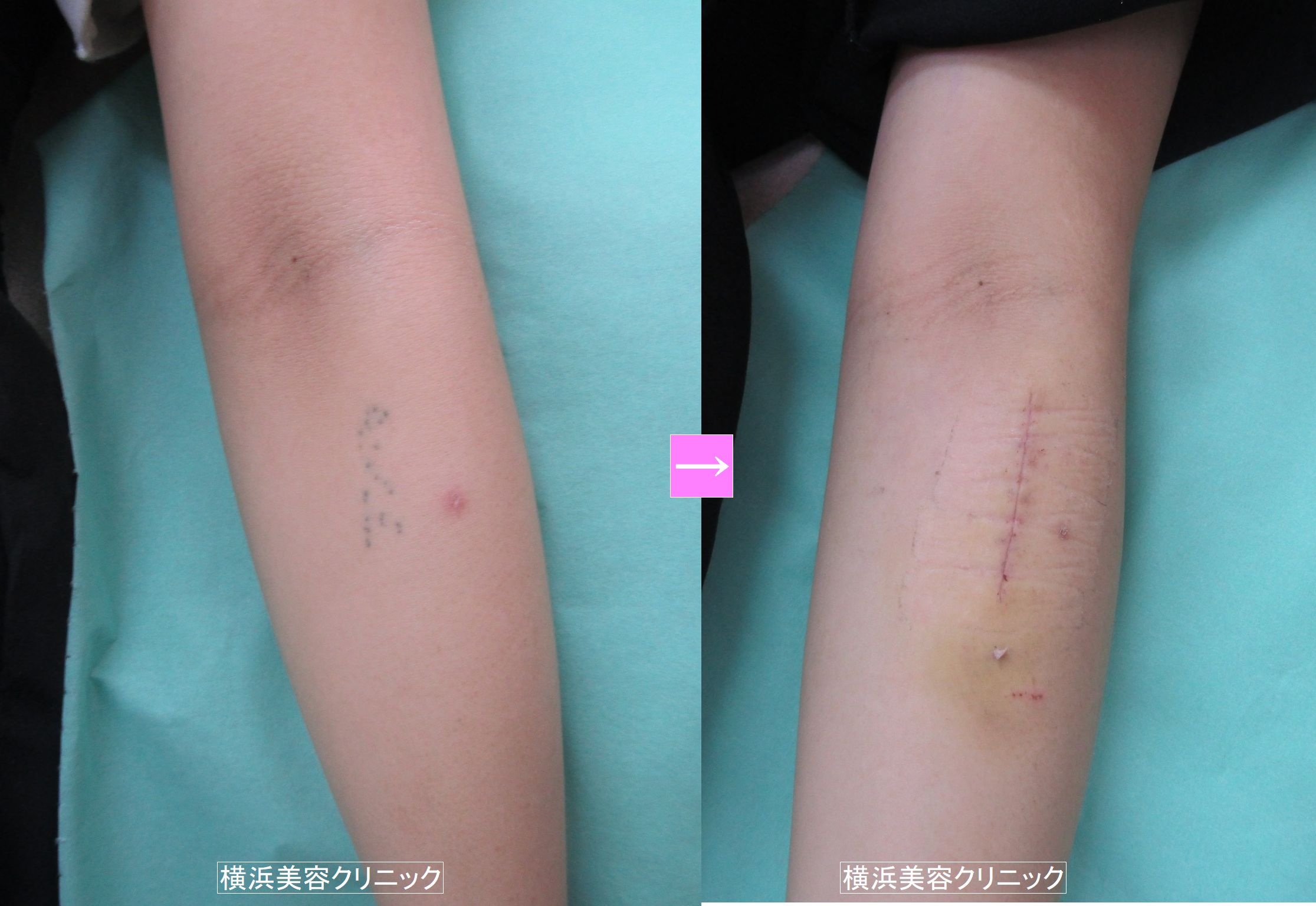 刺青除去 前腕 画像あり 横浜で働く美容外科院長の美容整形ここだけの話ブログ