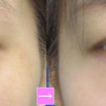 目の下のタルミ取り　（画像あり）