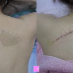刺青除去（背中）、レーザー治療との違い　（画像あり）