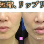 人中短縮術の噂話２（ほんとかうそか）２　（画像あり）