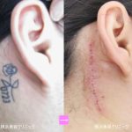 刺青（タトゥー）除去（首回り）　（画像あり）