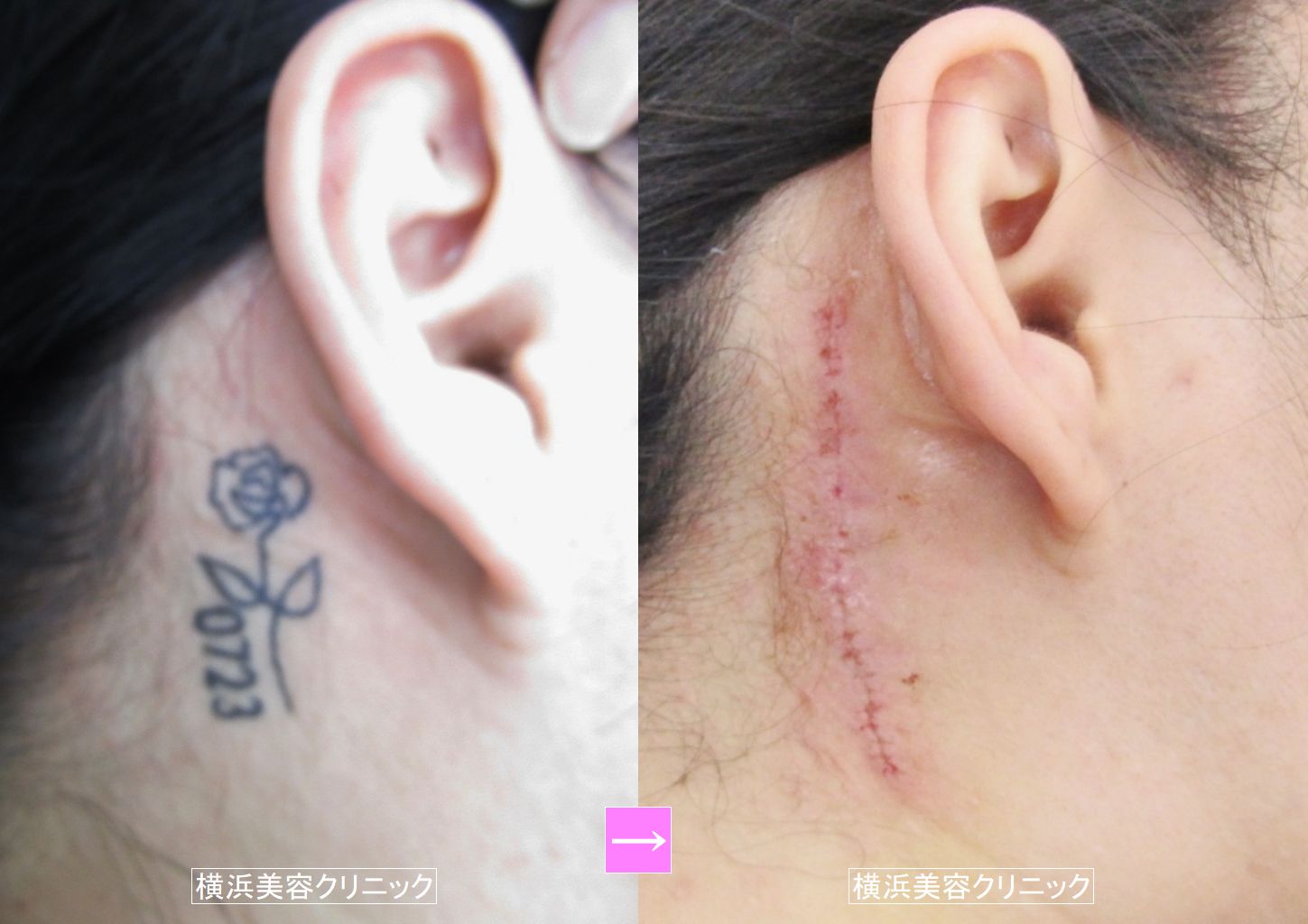 ピアス　脱毛　タトゥー　
新品 刺青（タトゥー）除去（首回り） （画像あり） | 横浜で働く美容外科