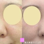 小鼻縮小は元に戻らない？（画像あり）