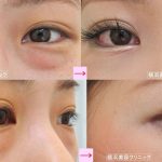 加齢による目の下のタルミは「くま」ではありません２　（画像あり）