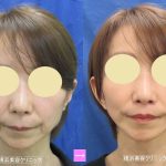 フェイスリフトと人中短縮の相乗効果　（画像あり）