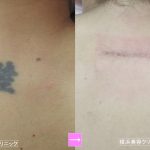 様々な部位の刺青（タトゥー）除去その１（画像あり）