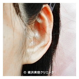 立ち耳・耳垂裂・ピアスホール形成　症例1