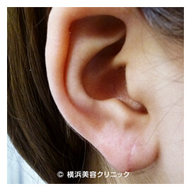 立ち耳・耳垂裂・ピアスホール形成　症例2