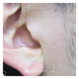 立ち耳・耳垂裂・ピアスホール形成　症例3