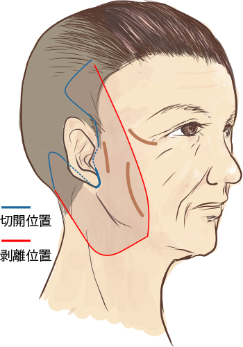 皮下剥離の基準範囲