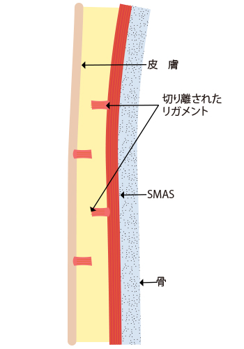 皮下剥離の基準範囲