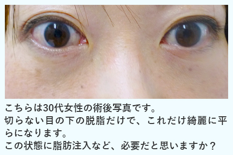 皮膚、皮下組織に弛みが生じると・・　眼窩脂肪