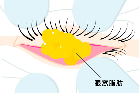 眼窩脂肪